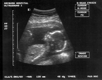 Ultrasound